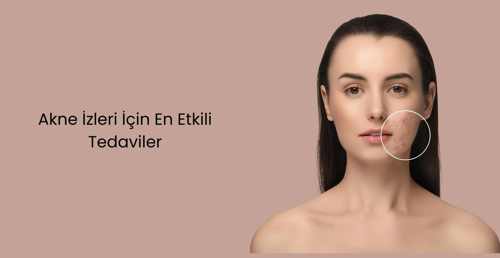 Temiz bir cilt için uzman lazerler, dolgu maddeleri ve mikroiğneleme-cerrahi olmayan çözümler ile sivilce izlerini hızla pürüzsüzleştirin.