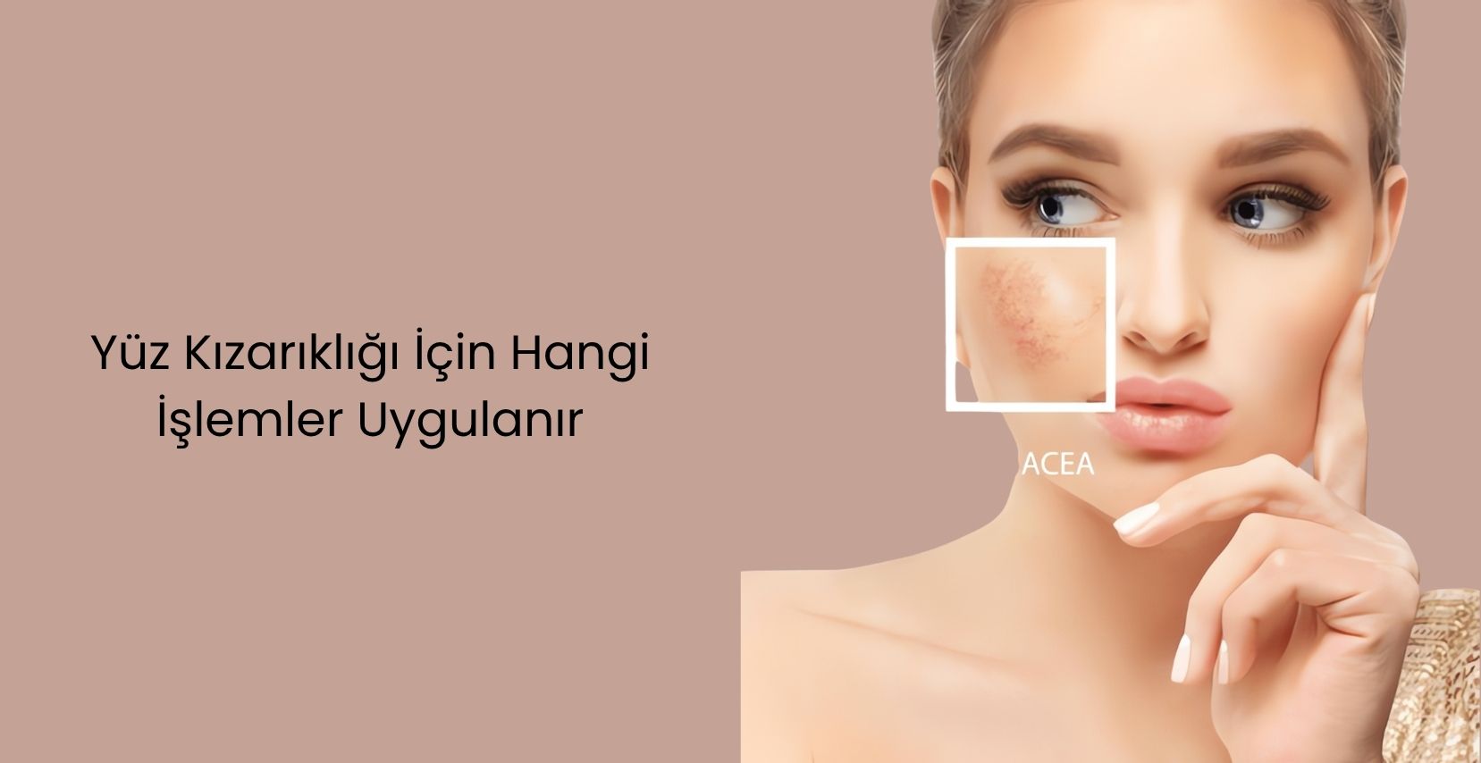 Uzman lazer, IPL ve medikal cilt bakımı tedavileriyle yüz kızarıklığını azaltın, sakin bir cilde kavuşun. Danışmanlığınızı bugün ayırtın!